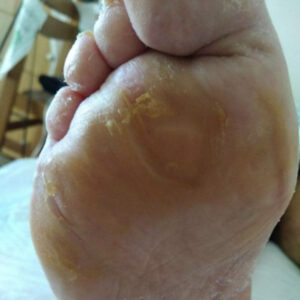 Diabetic Foot Neuropathic Plantar Ulcer outcome image