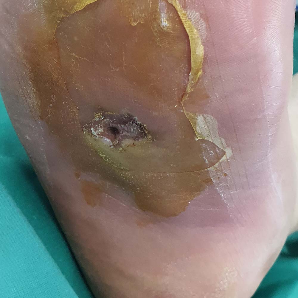 Diabetic Foot Plantar Abscess with Sepsis before image