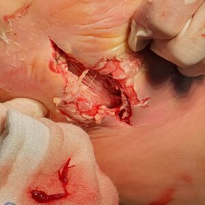 Diabetic Foot Plantar Abscess with Sepsis procedure image