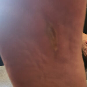 Diabetic Foot Plantar Abscess with Sepsis outcome image