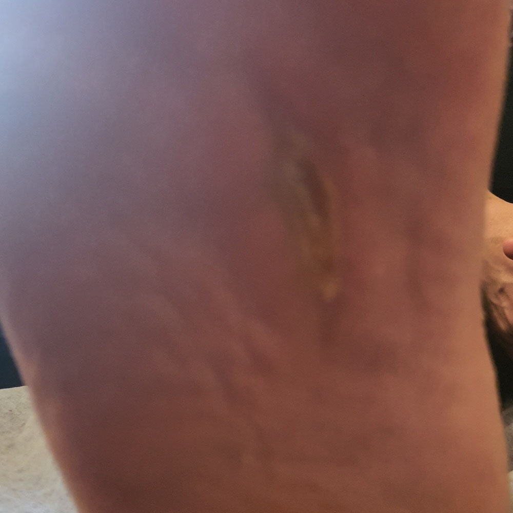 Diabetic Foot Plantar Abscess with Sepsis outcome image