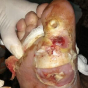 Diabetic Foot Plantar Sinus Tract Without Bone Resection before image