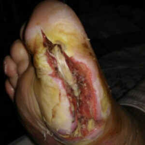 Diabetic Foot Plantar Sinus Tract Without Bone Resection procedure image