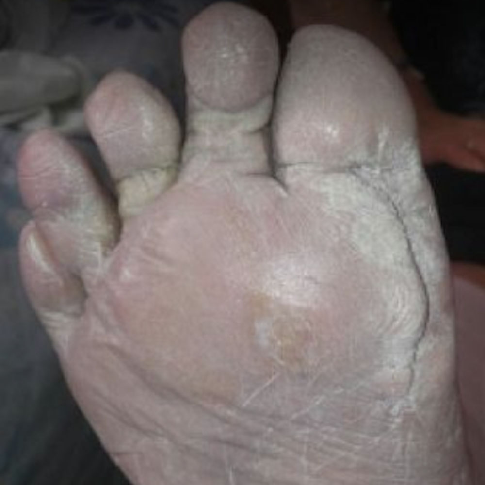 Diabetic Foot Plantar Sinus Tract Without Bone Resection outcome image