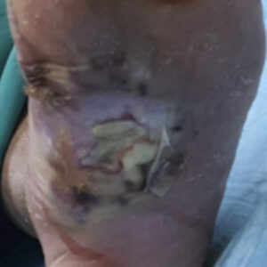 Diabetic Foot Plantar Ulcer with Infection and Critical Limb Ischemia before image