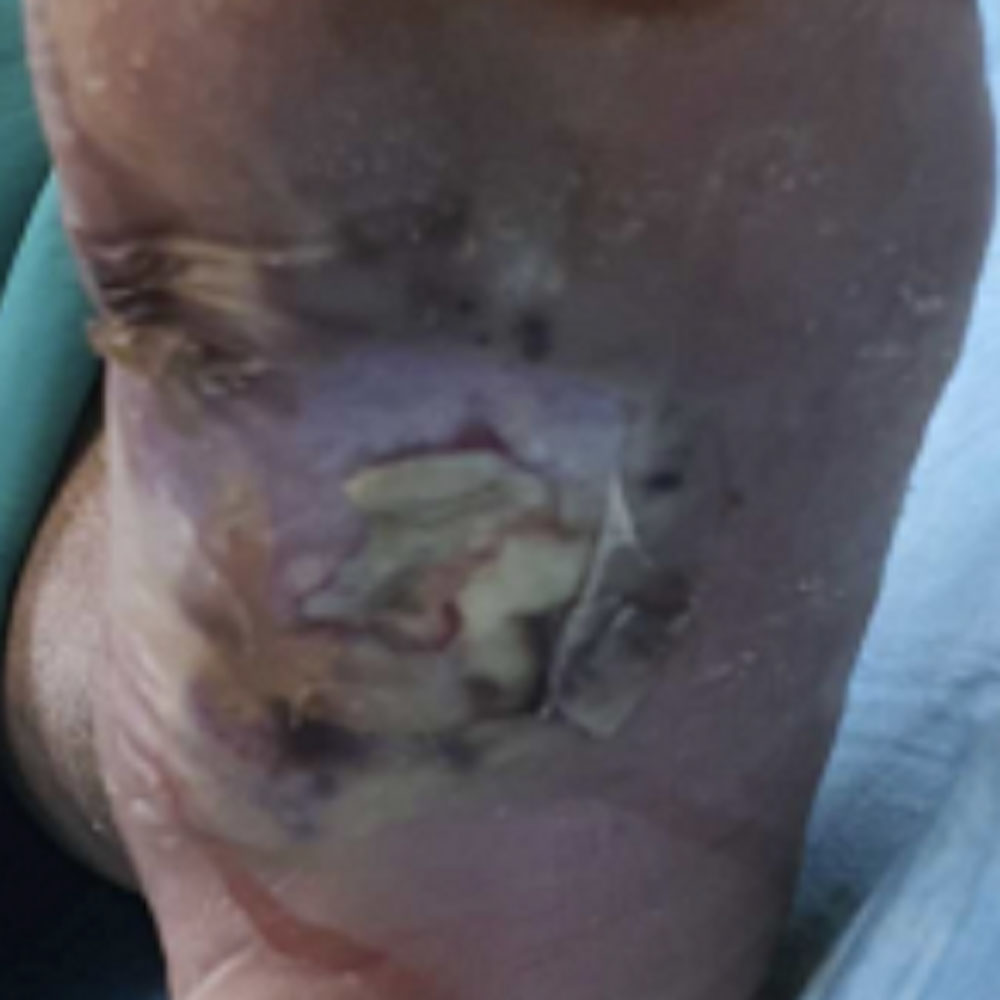 Diabetic Foot Plantar Ulcer with Infection and Critical Limb Ischemia before image