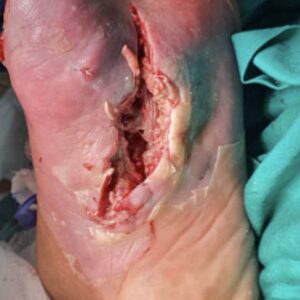 Diabetic Foot Plantar Ulcer with Infection and Critical Limb Ischemia procedure image