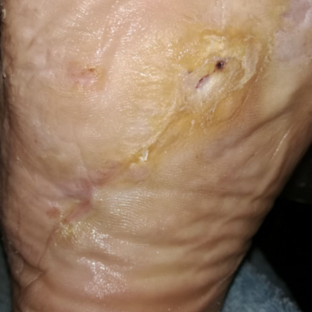 Diabetic Foot Plantar Ulcer with Infection and Critical Limb Ischemia outcome image