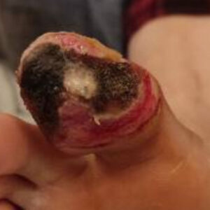 Diabetic Foot Toe Salvage Without Bone Resection image before
