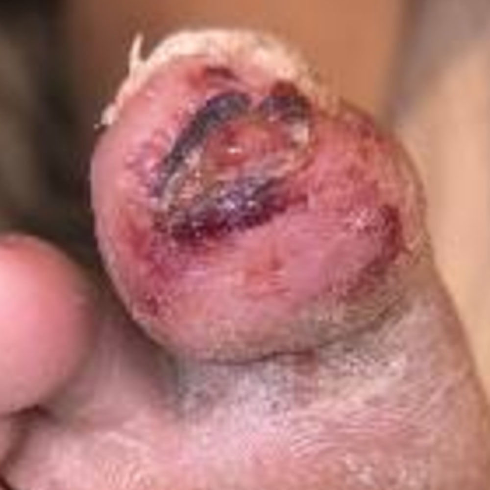 Diabetic Foot Toe Salvage Without Bone Resection image procedure