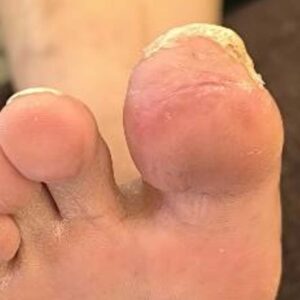 Diabetic Foot Toe Salvage Without Bone Resection image outcome