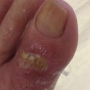 Diabetic Foot Toe Ulcer with Exposed Extensor Tendon before image