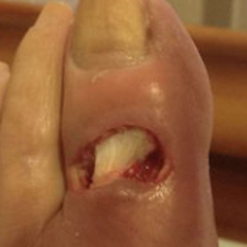 Diabetic Foot Toe Ulcer with Exposed Extensor Tendon procedure image