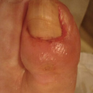 Diabetic Foot Toe Ulcer with Exposed Extensor Tendon outcome image