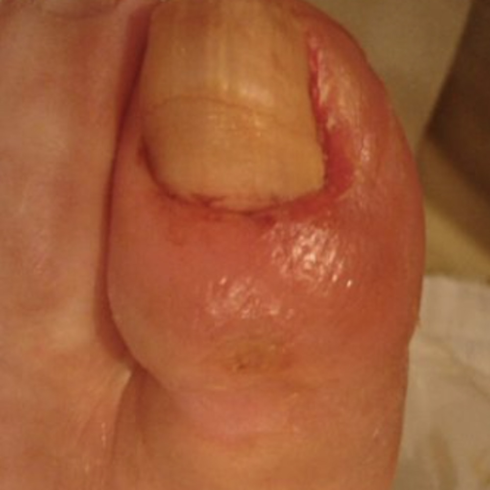 Diabetic Foot Toe Ulcer with Exposed Extensor Tendon outcome image