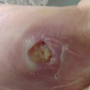 Diabetic Foot Ulcer Over the First Metatarsal Head (Hallux Valgus) before image