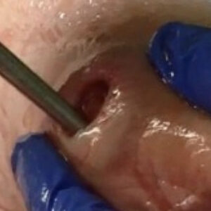 Diabetic Foot Ulcer Over the First Metatarsal Head (Hallux Valgus) procedure image