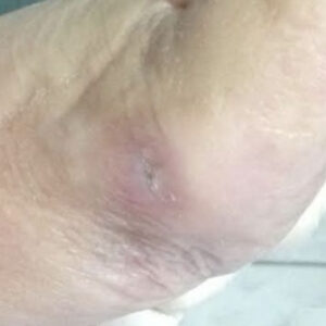 Diabetic Foot Ulcer Over the First Metatarsal Head (Hallux Valgus) outcome image