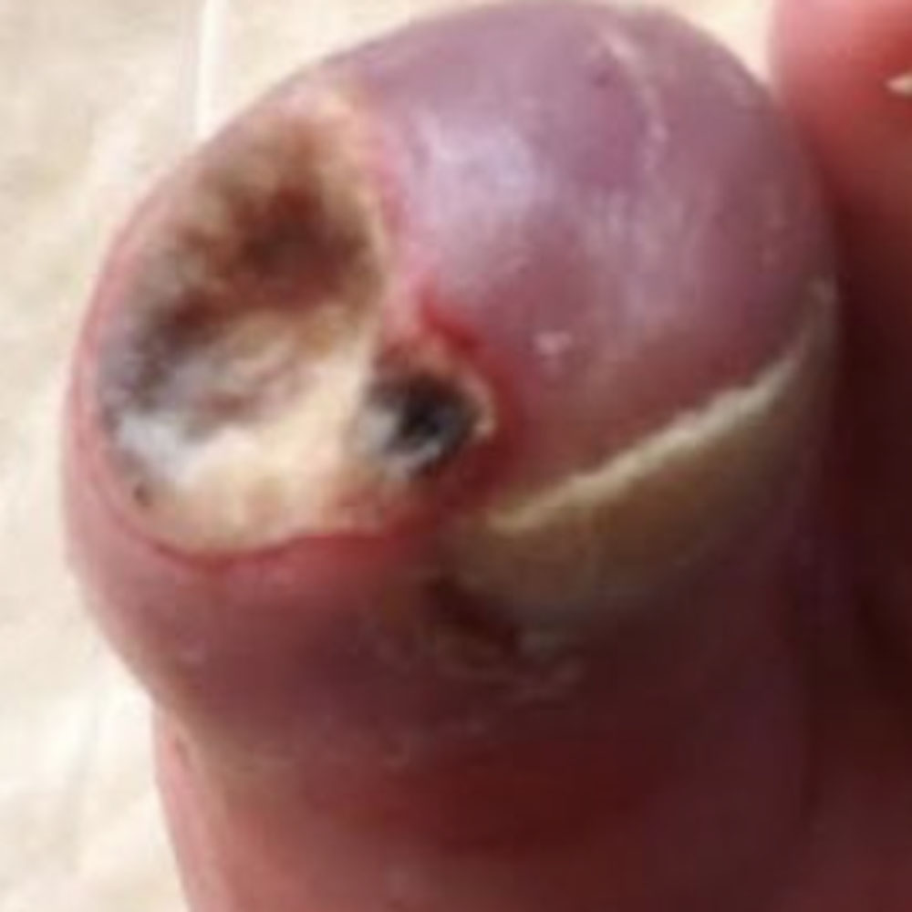 Diabetic Ischemic Toe Ulcer Following Revascularization before image