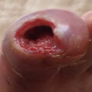Diabetic Ischemic Toe Ulcer Following Revascularization procedure image