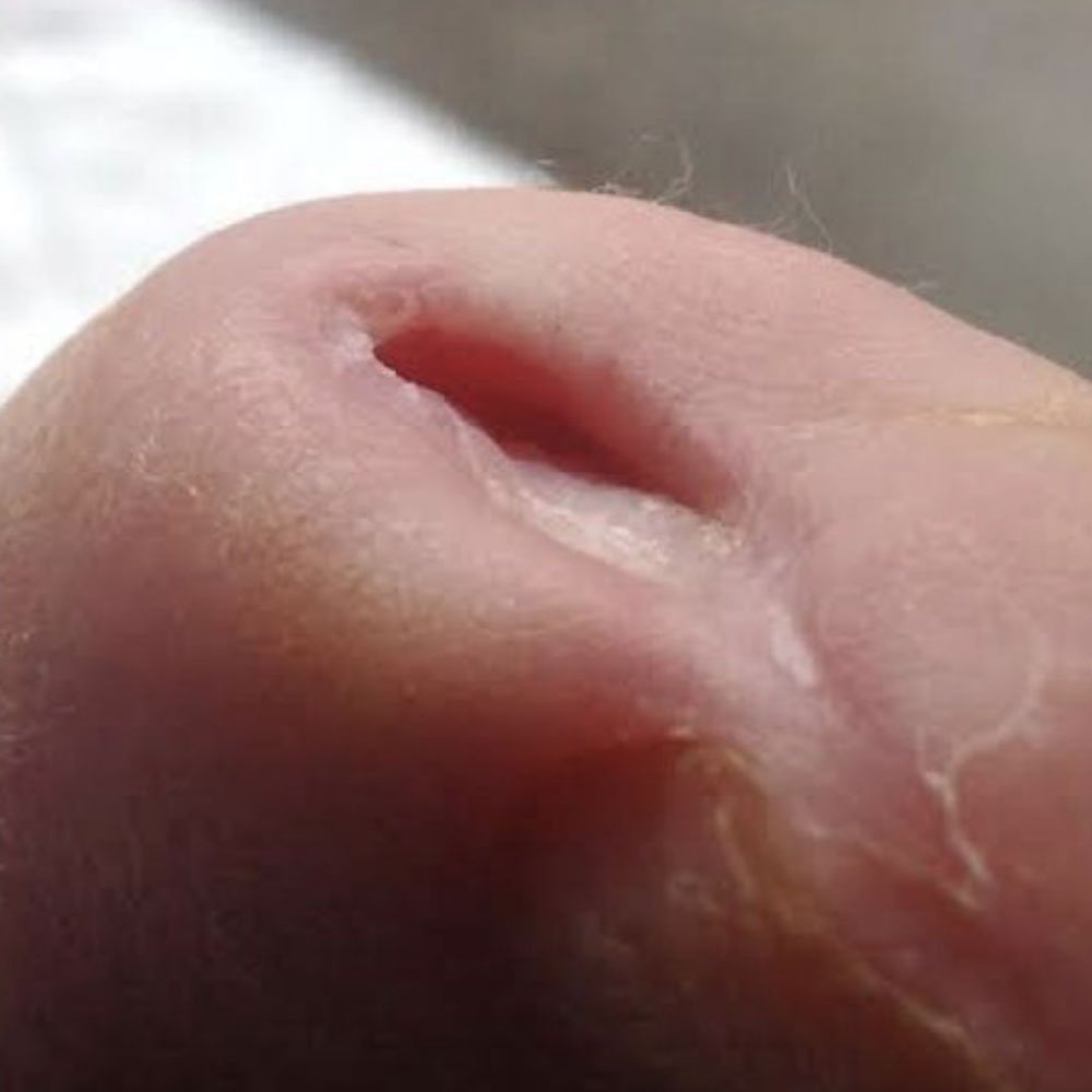 Diabetic Ischemic Toe Ulcer Following Revascularization outcome image