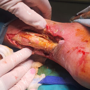 Exposed Achilles Tendon in an Elderly Patient before image