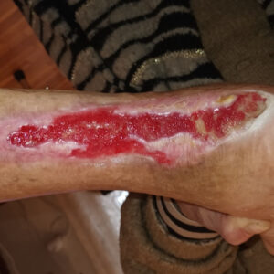 Exposed Achilles Tendon in an Elderly Patient procedure image