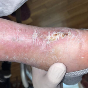 Exposed Achilles Tendon in an Elderly Patient outcome image