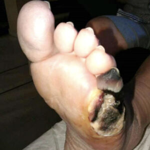 Fifth Ray Amputation After Revascularization before image