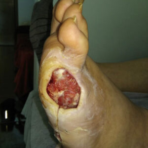 Fifth Ray Amputation After Revascularization procedure image