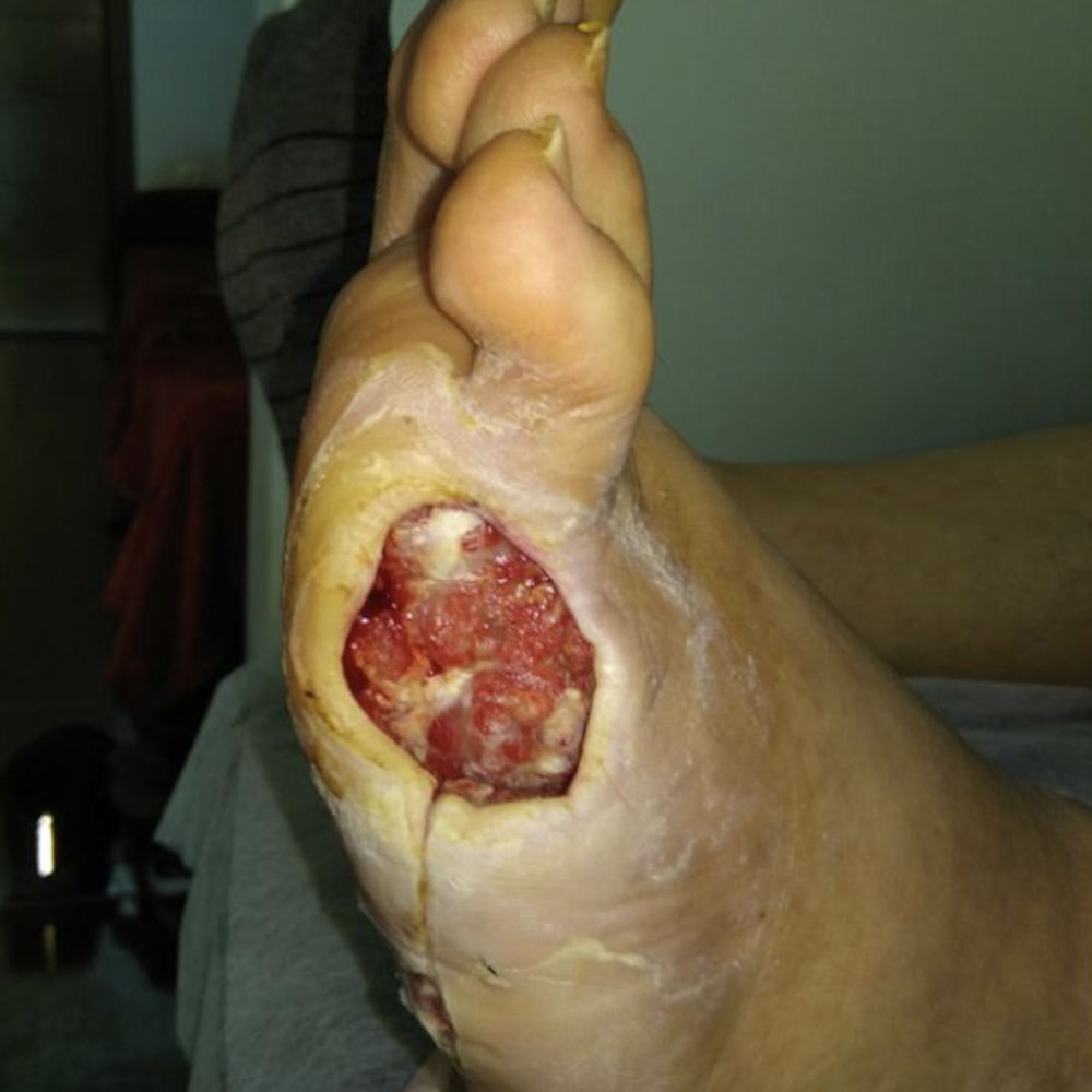 Fifth Ray Amputation After Revascularization procedure image