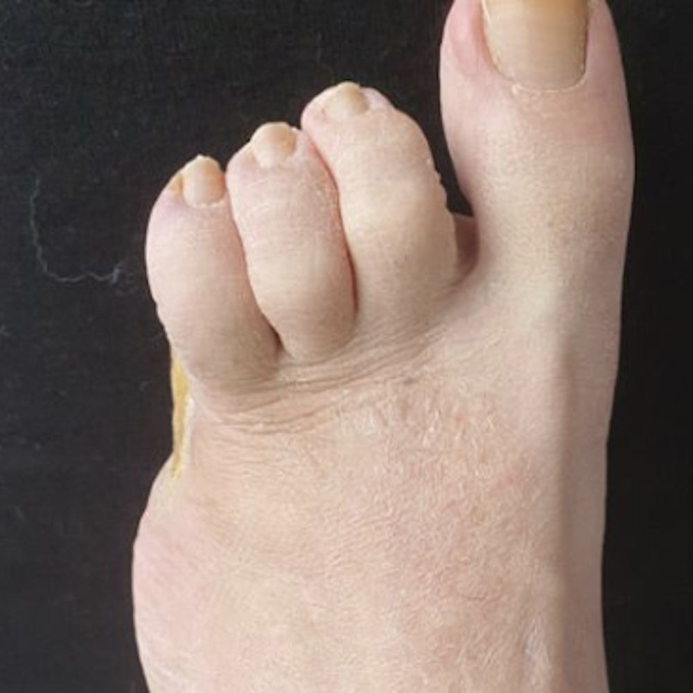 Fifth Ray Amputation After Revascularization outcome image