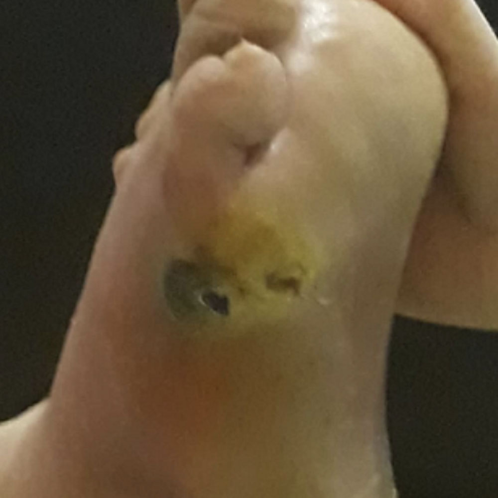 Fifth Ray Amputation for Ischemic Gangrene before image
