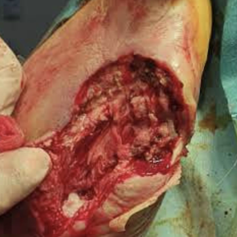 Fifth Ray Amputation for Ischemic Gangrene procedure image