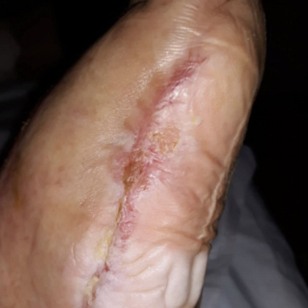 Fifth Ray Amputation for Ischemic Gangrene outcome image