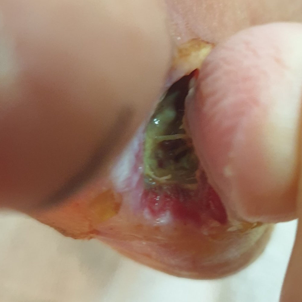 Fifth Toe Amputation with Metatarsal Head Preservation before image