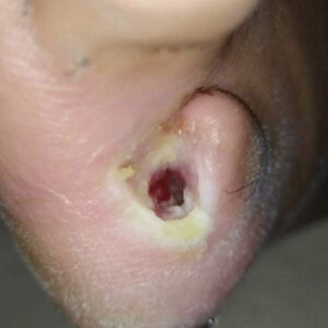 Fifth Toe Amputation with Metatarsal Head Preservation procedure image