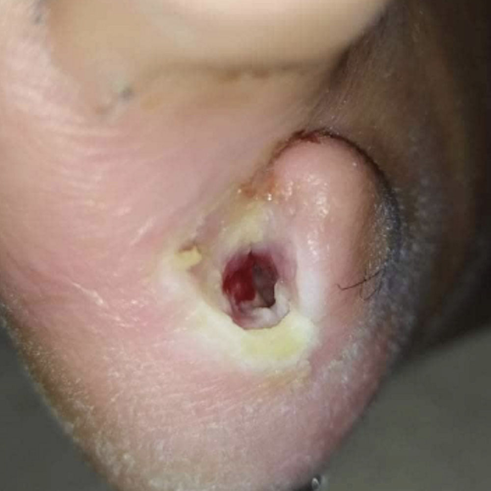 Fifth Toe Amputation with Metatarsal Head Preservation procedure image