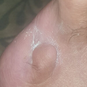 Fifth Toe Amputation with Metatarsal Head Preservation outcome image