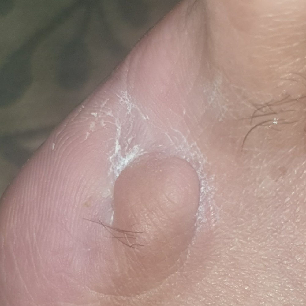 Fifth Toe Amputation with Metatarsal Head Preservation outcome image