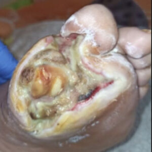 First Ray Amputation After Revascularization before image