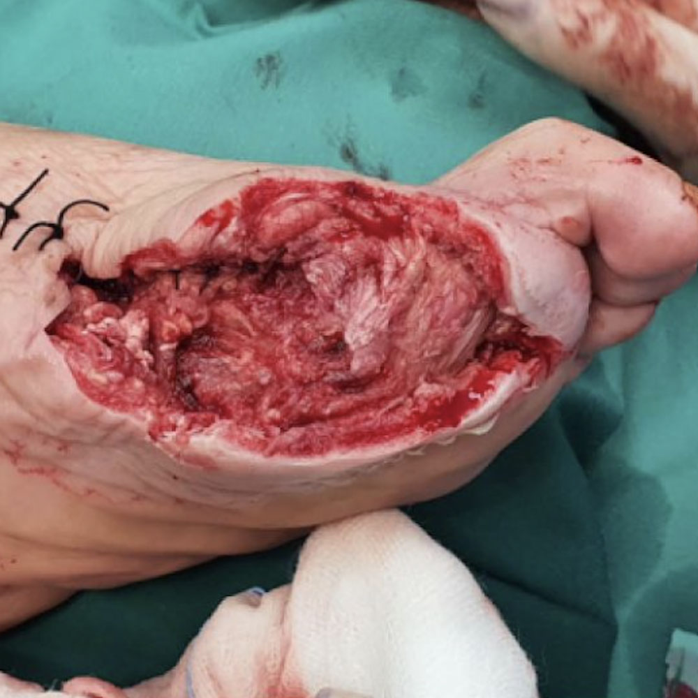 First Ray Amputation After Revascularization procedure image