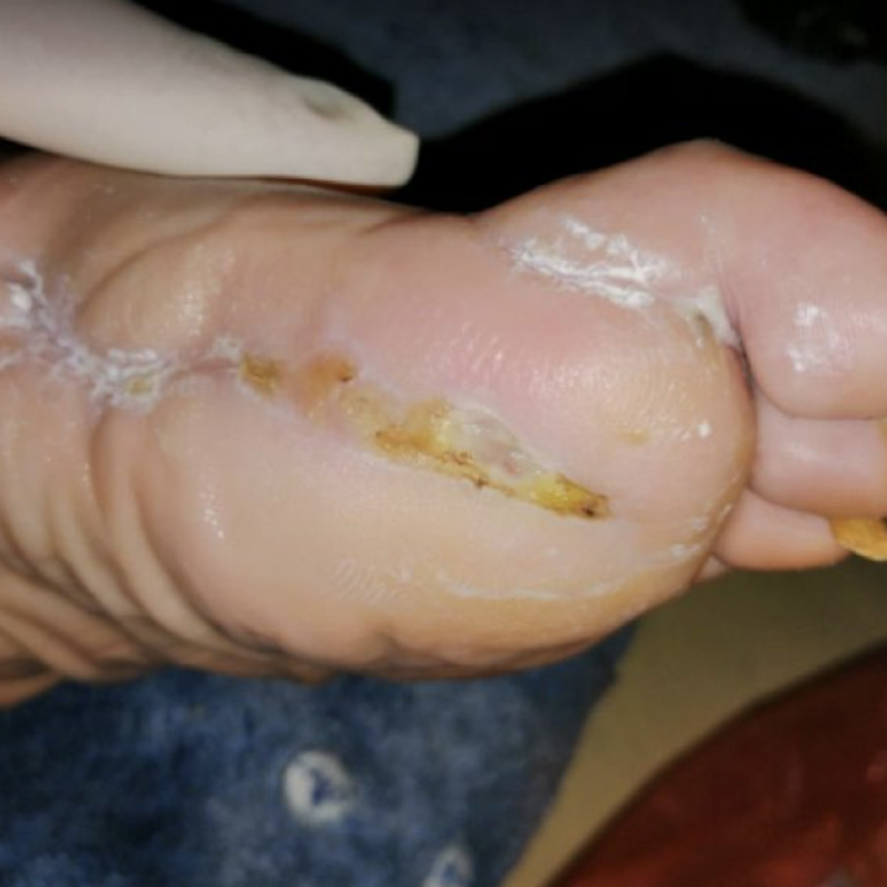 First Ray Amputation After Revascularization outcome image
