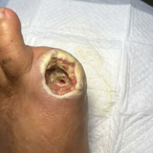 Hallux Amputation with First Metatarsal Head Preservation before image