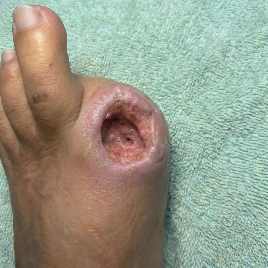 Hallux Amputation with First Metatarsal Head Preservation procedure image