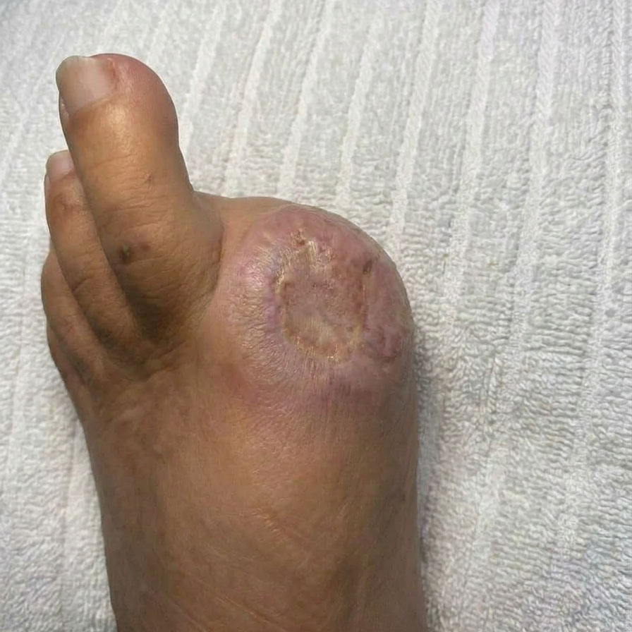 Hallux Amputation with First Metatarsal Head Preservation outcome image