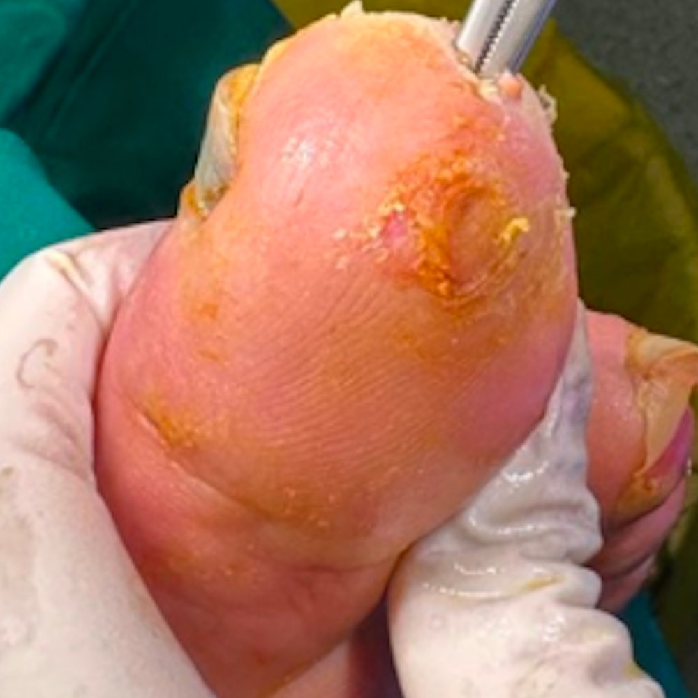 Hallux Osteomyelitis Treated with Phalangeal Resection and Toe Preservation before image