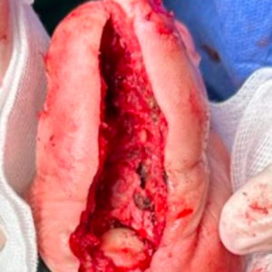 Hallux Osteomyelitis Treated with Phalangeal Resection and Toe Preservation procedure image