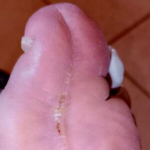Hallux Osteomyelitis Treated with Phalangeal Resection and Toe Preservation outcome image