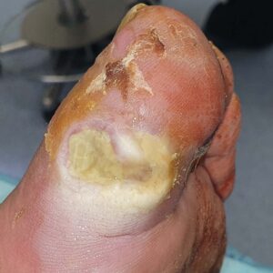 Hallux Phalanx Resection with Soft-Tissue Preservation before image